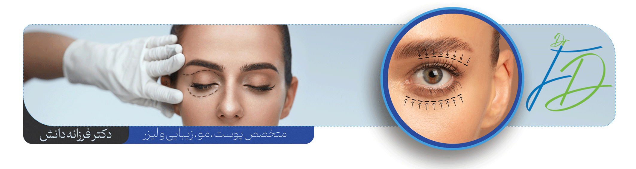 تزریق فیلر زیر چشم - کلینیک دانش